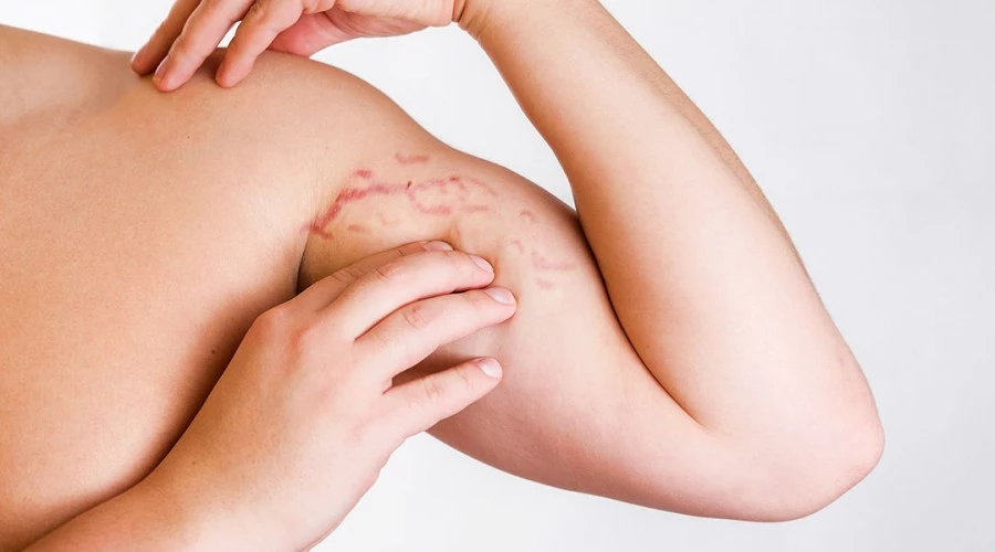 How to Care for Stretch Marks Before and After Weight Loss