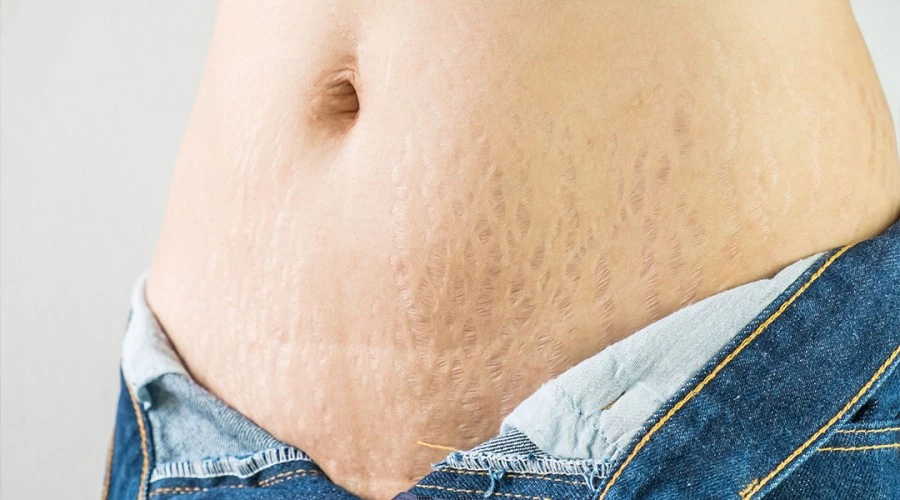 Do Stretch Marks From Puberty Go Away?
