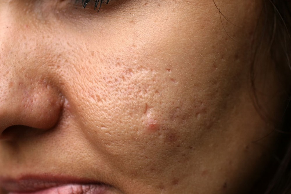 How To Care For Acne Scars Mederma®
