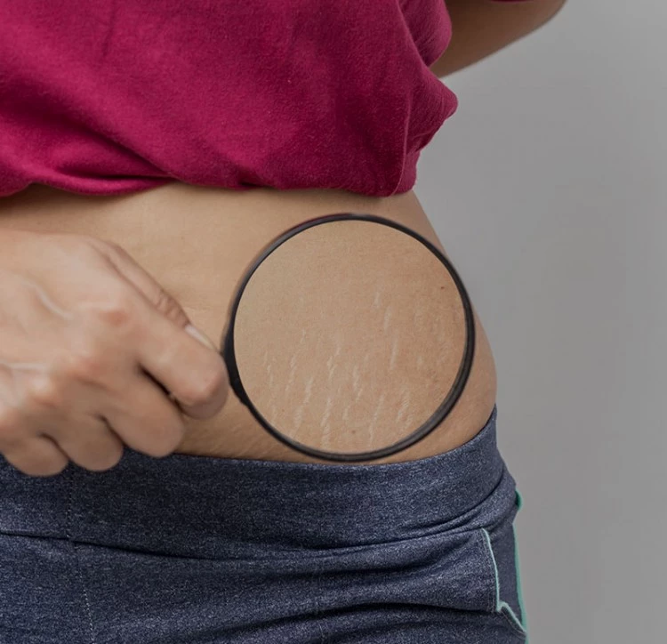 Laser Stretch Mark Removal Cost